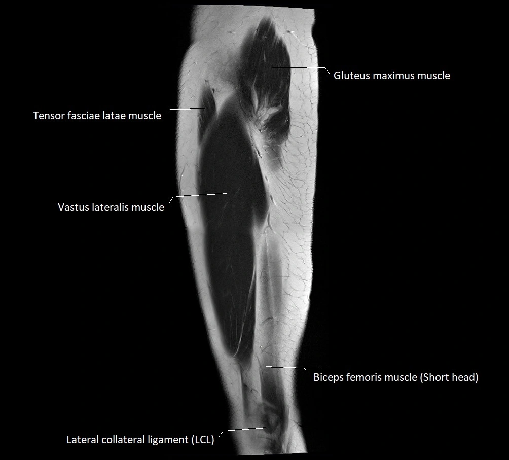 Thigh sagittal cross sectional anatomy MRI 3T image 3.webp
